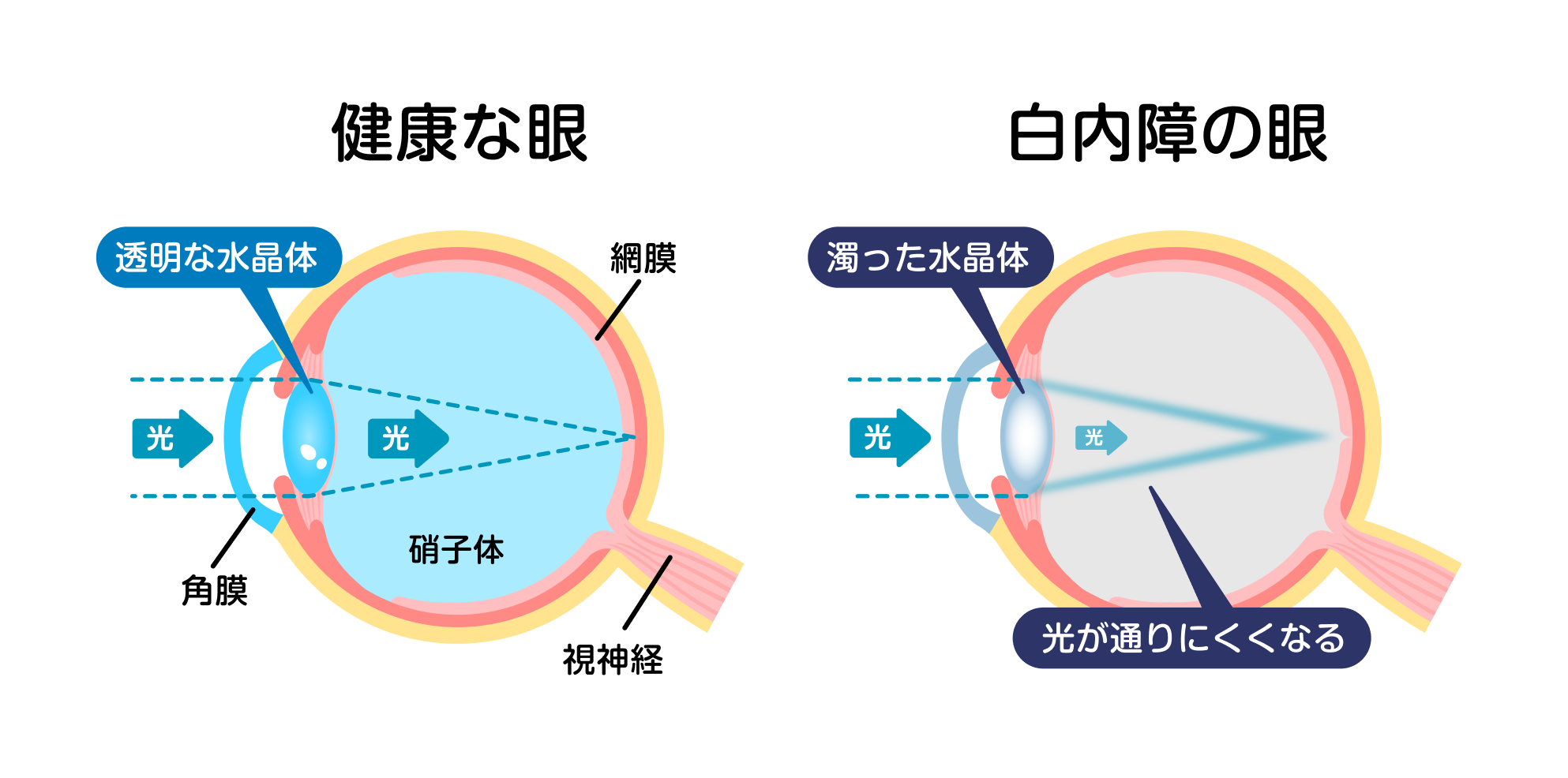 健康な眼と白内障の眼のメカニズム図