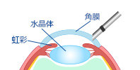 STEP1 角膜を切開