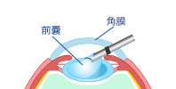 STEP2 前嚢を切開
