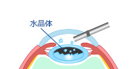 STEP3 水晶体を吸引