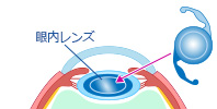 STEP4 眼内レンズの挿入