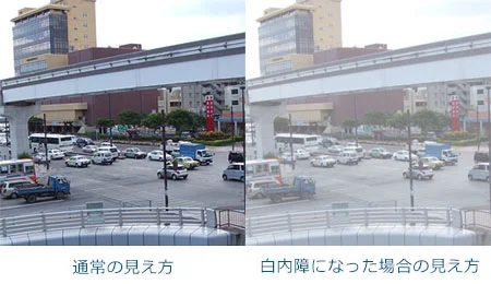通常の見え方と白内障になった場合の見え方の比較